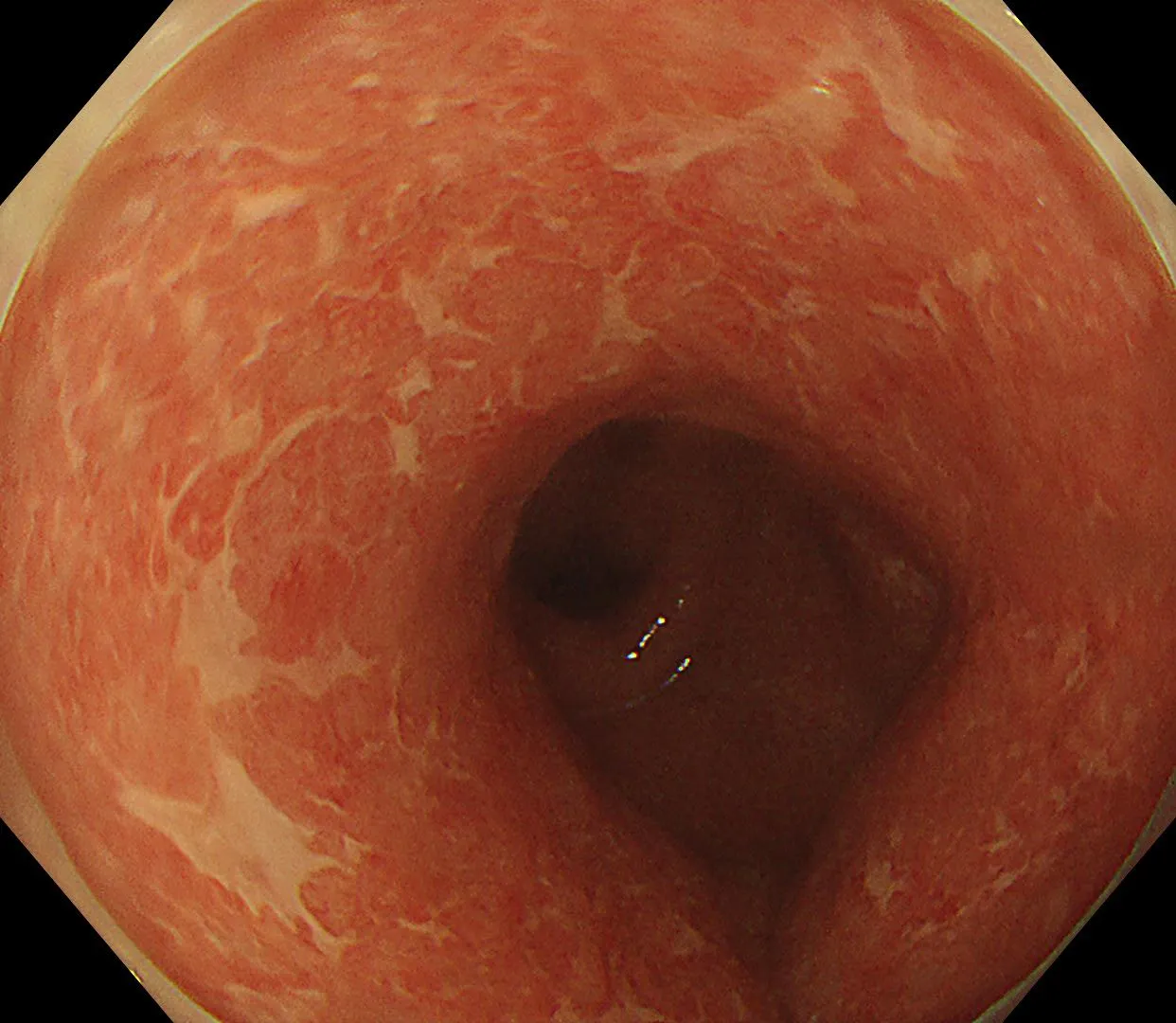 炎症性腸疾患